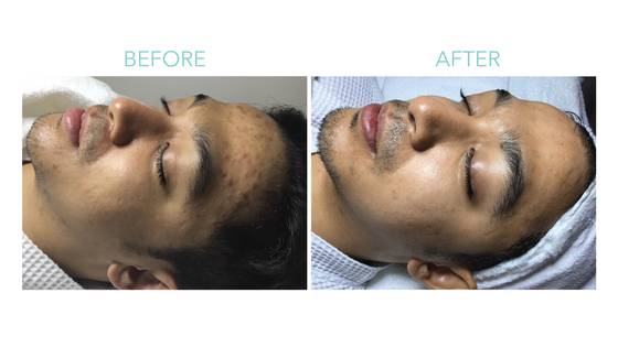 Recovering from major breakouts after laser